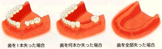 福津 インプラントの歯科（歯医者）